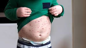 Image result for chickenpox