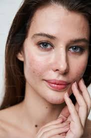 Image result for acne face