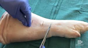 We did not find results for: Hd Vertical Mattress Suture Em Rap