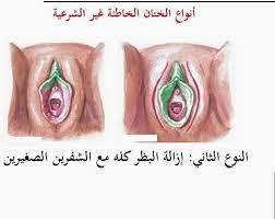 مراحل شفاء الختان بالصور للذكور والإناث زيادة