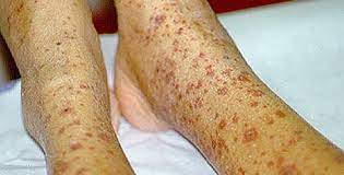 The initial signs of senile purpura are purple or red bruises that have an irregular shape. Symptoms Of Vasculitis Johns Hopkins Vasculitis Center