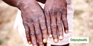 We did not find results for: Monkeypox Virus In Singapore Symptoms And Treatment Guidelines