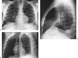Often visible, right kidney lower than. Radiographic Evaluation Of The Lungs And Chest Thoracic Key