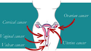 They can be caused by other conditions. Cancer And The Pelvic Floor Inner Active Pelvic Health Physiotherapy