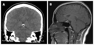 Image result for Incidental Imaging Finding