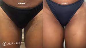 Check spelling or type a new query. Pulse Light Clinic On Twitter Ingrown Hair Reduction Our Client Results Before And After 8 Laser Hair Removal Treatments On The Bikini Area