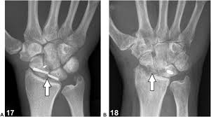Image result for Scapholunate Dislocation