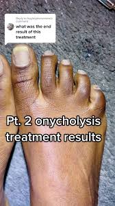 Image result for Onycholysis feet