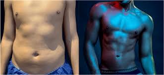 Image result for Liposuction