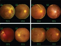 This is because diabetes can lead to eye problems, such as diabetic retinopathy. Vitrectomy In Advanced Diabetic Eye Disease A Seremban Experience Raman P Livingstone Bi J Diabetol