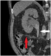 Image result for Helical CT Urogram