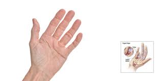 Image result for Trigger Finger