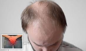 Does your hair suddenly seems a lot thinner? Hair Loss Patchy Bald Spots Could Regrow Hair If An Underlying Sti Is Treated Express Co Uk