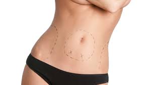 Ennis is pleased to offer drainless tummy tuck, an innovative surgical technique that can eliminate the need for surgical drains in abdominoplasty. Where Does The Fluid Go In A Drainless Tummy Tuck