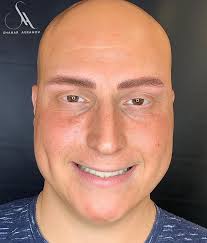 תכירו את עמנואל- לא הוא לא חולה במחלה . וגם לא במשהו שתכירו. הוא חולה במחלת  האלופציה. עכשיו תתארו לעצמכם סיטואציה שכל בוקר אתם קמים ואזור אחר בגוף שלכם  מתרוקן משיער. זה