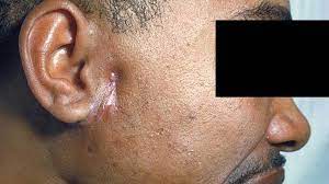 Facial Swelling Causes Symptoms Treatments And More