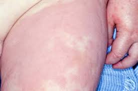 Image result for allergy rash on the legs