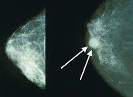 What does a tumor look like on an x ray. Breast Cancer Wikipedia
