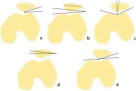 Image result for Patellar Tilt Test
