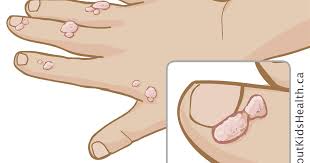Plantar warts are caused by the same type of virus that causes warts on your hands and fingers. Human Papilloma Virus Hpv And Genital Warts