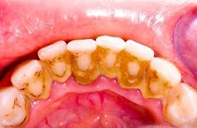 Did you know 68% of adults have tartar? Bleeding Gums The Bloody Truth Minovi Dental