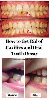 How To Get Rid Of Cavities And Heal Tooth Decay Dental Decay Tooth Decay Healthy Teeth
