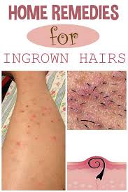 Even more so if they become infected and painful. 47 Ingrown Hairs Ideas Ingrown Hair Ingrown Hair Remedies Ingrown Hair Removal