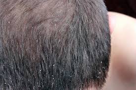 Image result for lice vs dandruff