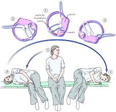 Analysis of 44 cases treated by the canalith repositioning procedure of prokopakis e.p., chimona t., tsagournisakis m., et al. Diagnosis And Management Of Benign Paroxysmal Positional Vertigo Bppv Cmaj