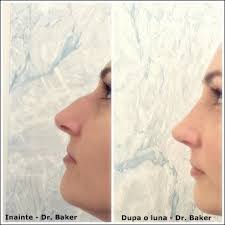 Rinoplastia sau operatia de corectie a nasului: Rinoplastie Operatii La Nas Home Facebook