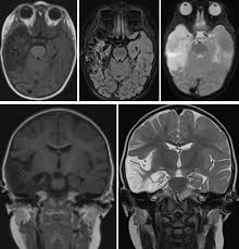 Encephalitis is a rare brain inflammation caused by a virus. Revista De Pediatria De Atencion Primaria Importancia Del Diagnostico Y Tratamiento Precoz De La Encefalitis Herpetica