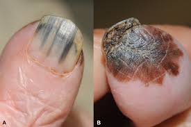Image result for Acral lentiginous melanoma nail