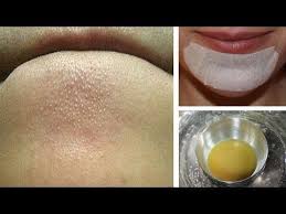 Pin On Nose Black Head