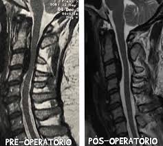Ossificação do ligamento longitudinal e dor cervical