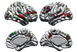 A study published earlier in 2018 should have made headlines everywhere, as it discovered historically high amounts of aluminum in autistic brains. Brain Anatomy Differences In Autism May Vary By Age Sex Spectrum Autism Research News