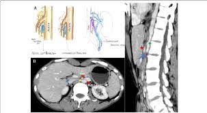 27 Year Old Male With Nutcracker Syndrome A Shows Hand Diagram In Download Scientific Diagram