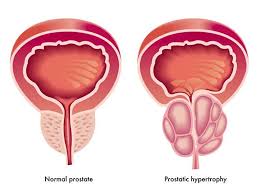 Learn about detection, diagnostic approaches, treatment options and advances for prostate cancer, including robotic prostatectomy and current research. Psma Vaccines Creative Biolabs