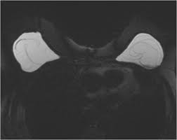 If you have silicone breast implants and suspect that an implant might have ruptured, talk to your plastic surgeon. Novel Decision Algorithm For The Diagnosis Of Silicone Gel Breast Implant Ruptures Springerlink