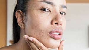 Check spelling or type a new query. Adult Acne 10 Surprising Causes And How To Get Rid Of It Everyday Health
