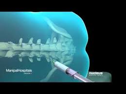 This Video Is An Informative Animated Presentation That Explains In Detail About Spinal And Epidural Anesthesia If You Are Having Certain Operations Su Epidural
