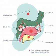 Die leber ist das größte entgiftungsorgan des menschlichen körpers. Endometriose Meine Pille