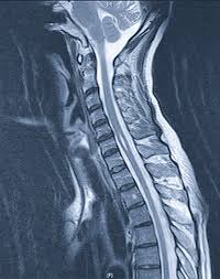 Syringomyelie Behandlung Symptome Therapie Operation