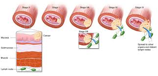 Pathology Outlines Tnm Staging Of Esophageal Carcinomas