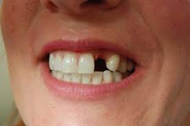 4 Best Alternatives To Dental Implants 3 Other Techniques