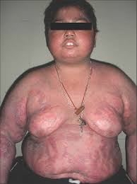 Moon Face Cushing S Syndrome Diagnosis Treatment