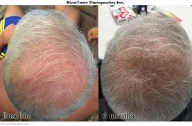 Studies have shown that topical application of nizoral's active drug ingredient ketoconazole can produce hair growth results comparable to minoxidil. Nizoral Wash Down Ceiling At Home India Nizoral Dr Max Ketoconazole Shampoo Hair Growth Reddit