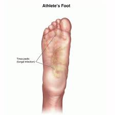 Athlete S Foot Infection Causes Cures Fast Treatment Remedies Mountainside Medical Equipment