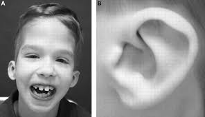 Clinical Experience In The Evaluation Of 30 Patients With A Prior Diagnosis Of Fg Syndrome Journal Of Medical Genetics