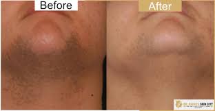 The damaged vessels inside the tumor are the reason for its bright red color. Dr Rachi S Skin City Laser For Removal Of Skin Tags Dpn Mole Cherry Angioma Skin Tag Treatment In Vadodara Alkapuri Dpn Removal From Skin Skin Moles Treatment In Vadodara Laser