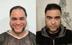 Confident Hair Transplant in Dominican Republic